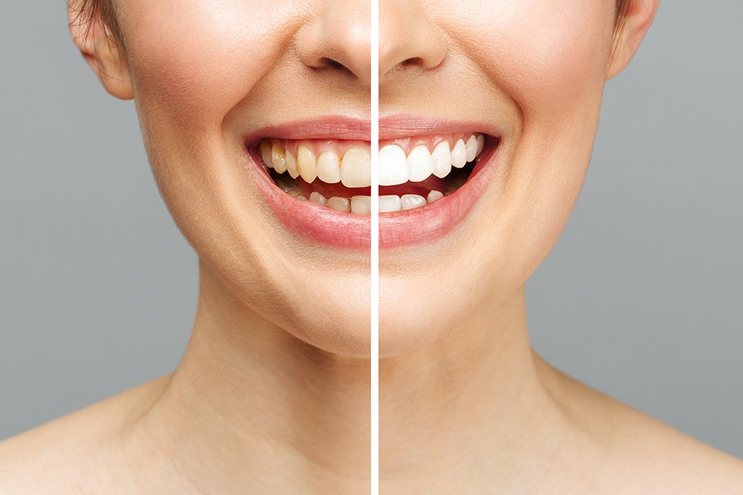 woman teeth before and after whitening. Over white background. Dental clinic patient. Image symbolizes oral care dentistry, stomatology